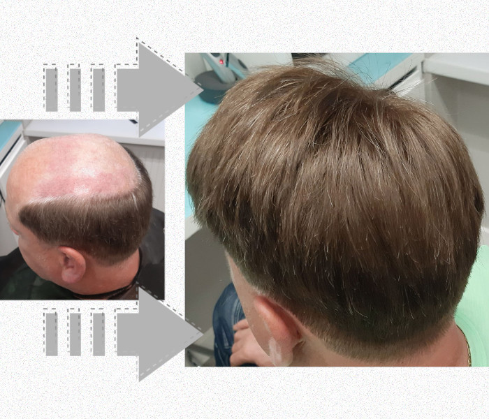 Czy warto zainwestować w&nbsp;system włosów?